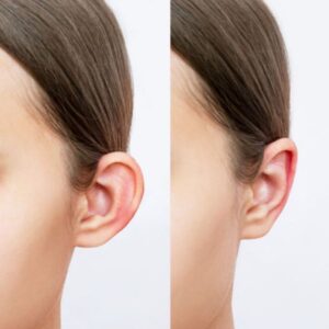 otoplastia orelhas de abano clinica humanitare site.jpg