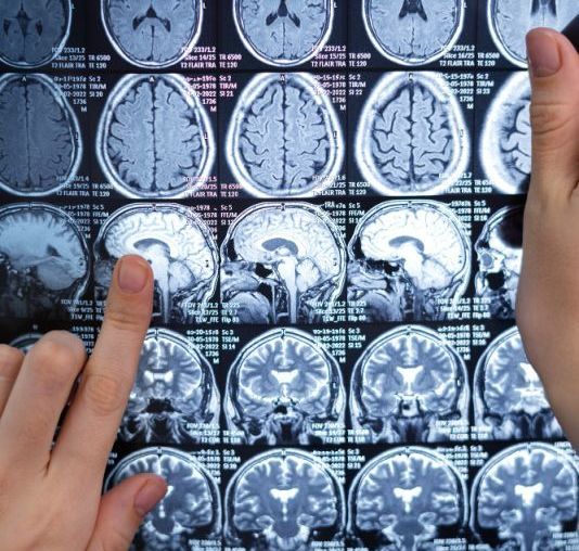 Tomografia cerebral - ataque isquêmico transitório