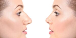 Rinoplastia site 51140d5d.jpg